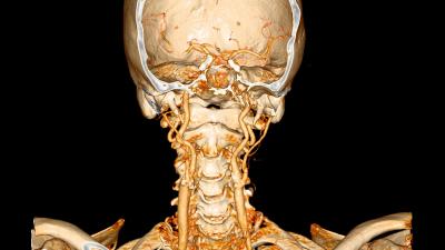 Computed Tomography Image